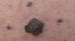 How to Prepare for Your Mohs Skin Cancer Surgery Appointment