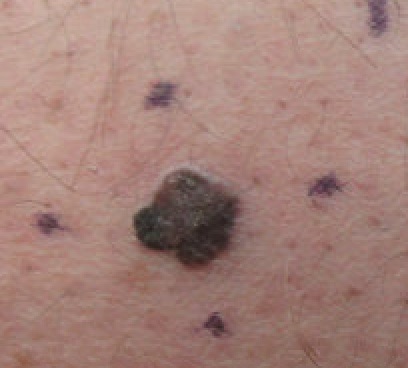 How to Prepare for Your Mohs Skin Cancer Surgery Appointment