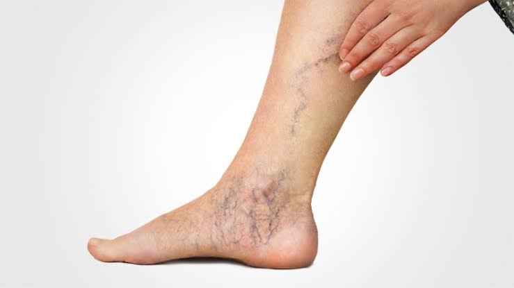 Recognizing and Treating Varicose Veins